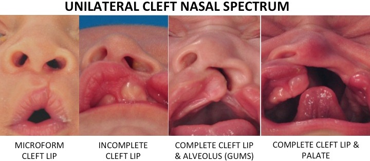 Unilateral cleft lip and palate