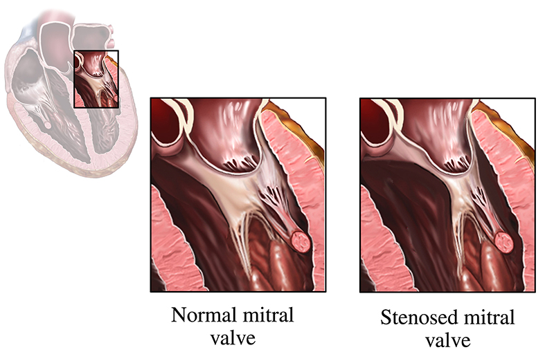 mitral stenosis showing normal mitral valve and stenosed mitral valve in the heart