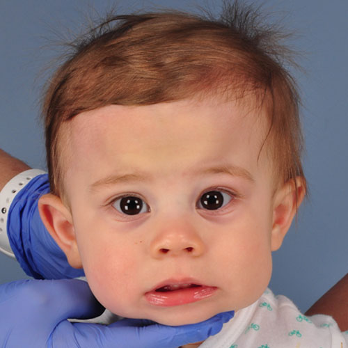 baby with metopic craniosynostosis before strip craniectomy