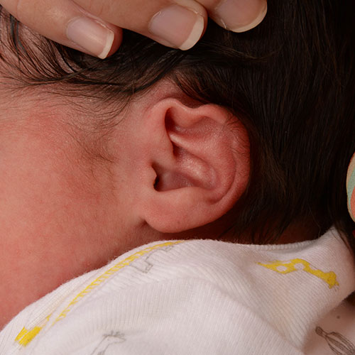 Helical rim deformity in an a baby's ear before ear molding treatment