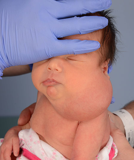 before venolymphatic malformation removal from infant