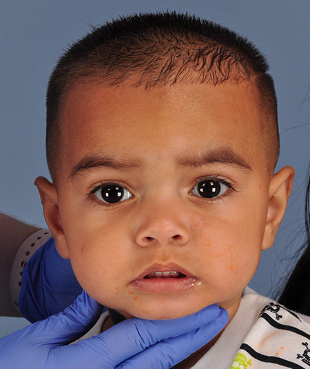 after photo of toddler boy with hemangioma removed