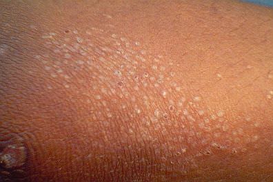 child's skin with lichen nitidus