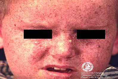 child's face with xeroderma pigmentosum