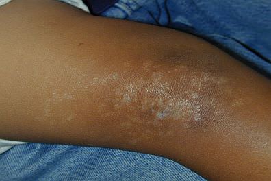 Child's skin with lichen striatus