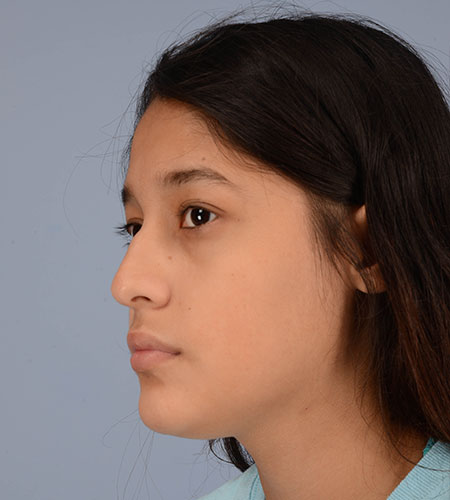 girl before rhinoplasty after nasal trauma