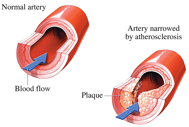 normal artery and artery narrowed by atherosclerosis