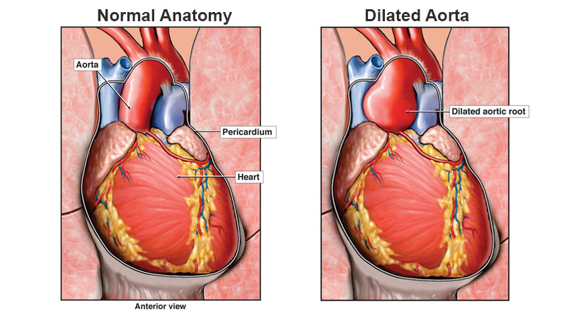 normal aorta, dilated aorta and corrected aorta