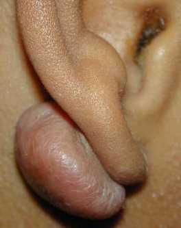 Child's ear with a keloid