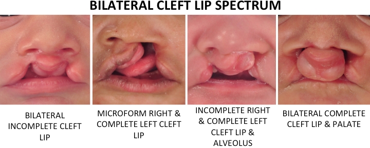 images showing the spectrum of severity that bilateral cleft lip