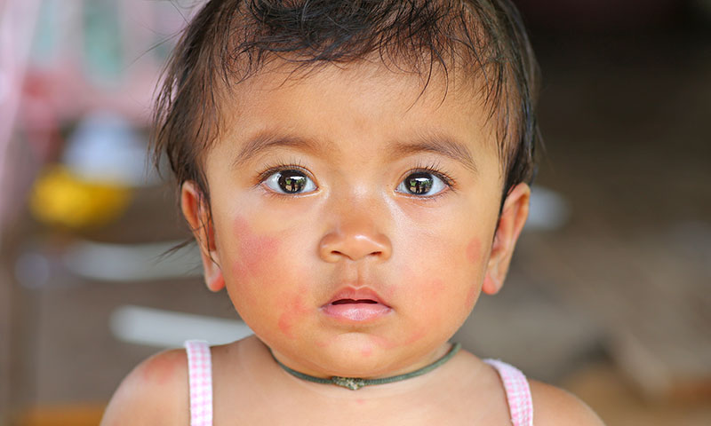 Little Hispanic girl with a rash on her face