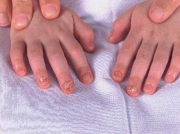 child fingers with twenty nail dystrophy