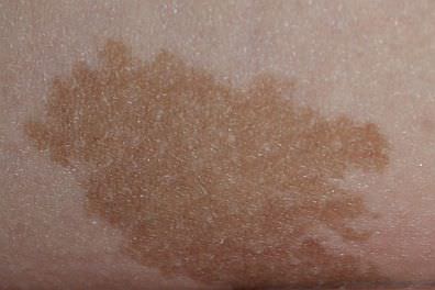 Child's skin with congenital nevus