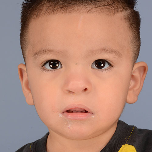 after photo of a child treated for cleft lip