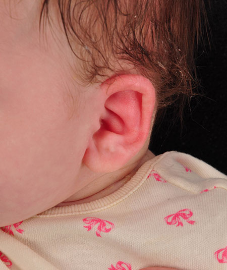 baby after ear molding treatment for constricted ear