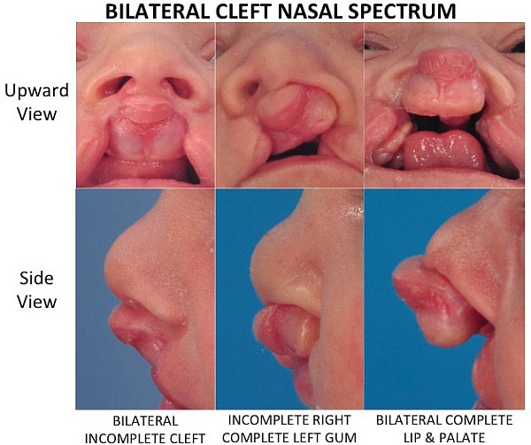 Images showing the spectrum of severity that bilateral cleft lip has on the nose