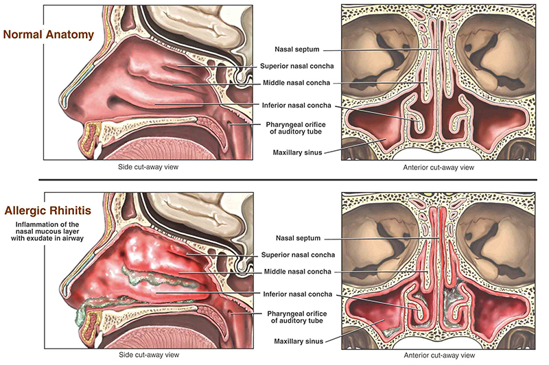 allergic rhinitis illustration of inside the nasal cavity
