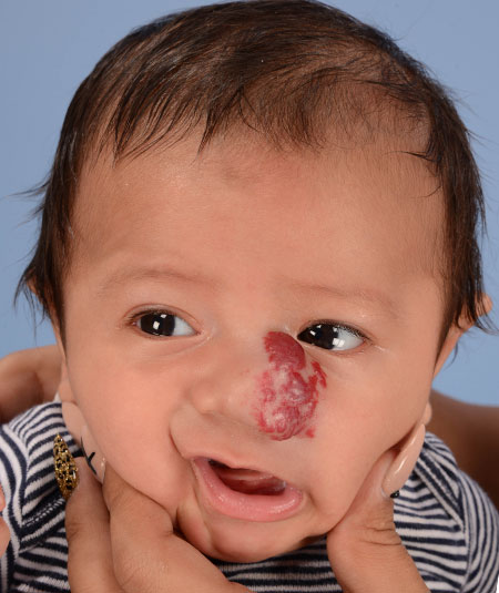before photo baby boy with nasal hemangioma