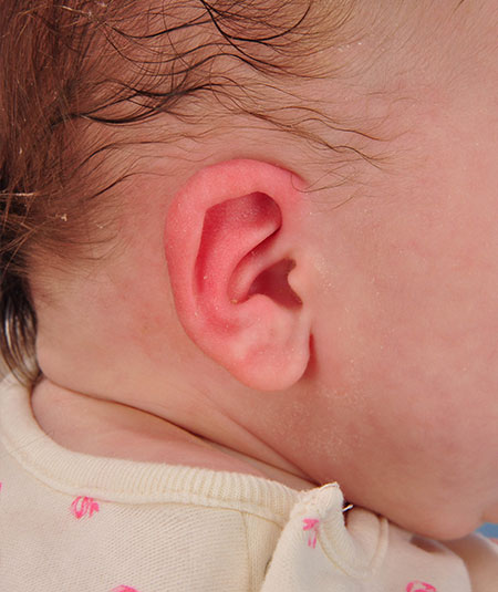 baby after ear molding treatment for constricted ear