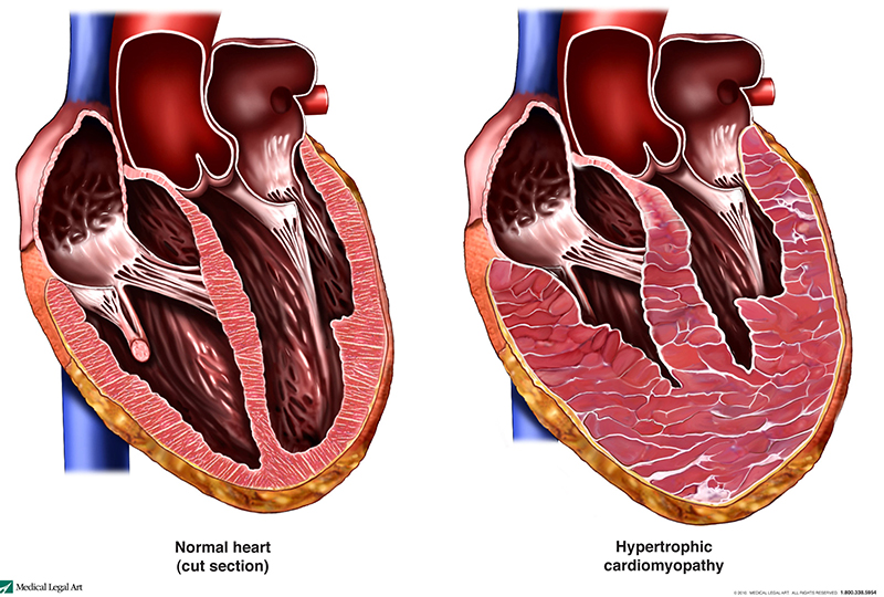 a normal heart compared to a heart with hypertrophic cardiomyopathy