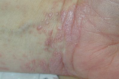 child's wrist with lichen planus