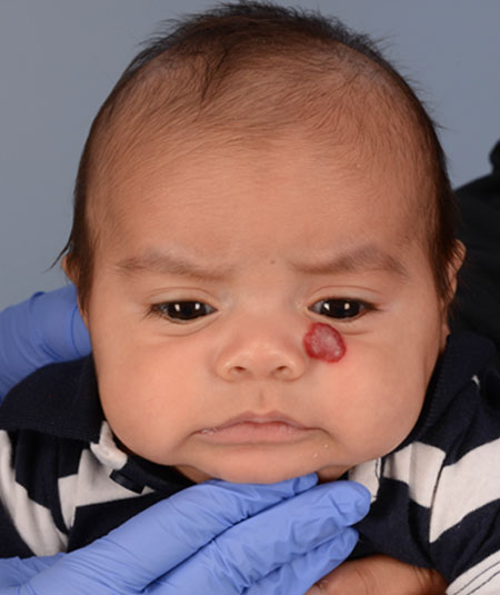 before photo baby boy with hemangioma under his eye