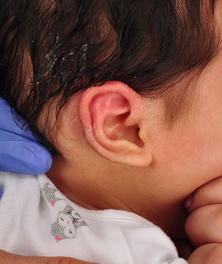 baby after ear molding treatment for helical kinking of the ear