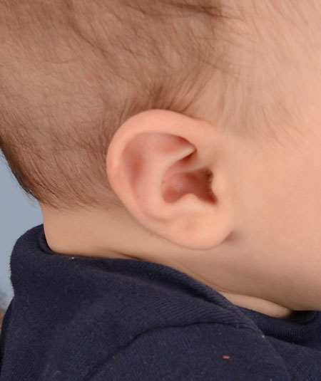 baby's ear after undergoing ear molding treatment for Stahl's ear