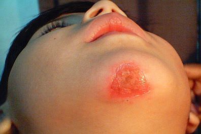 Young child with impetigo on his chin