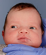 before image of infant with craniosynostosis