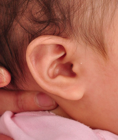 infant's ear after ear molding