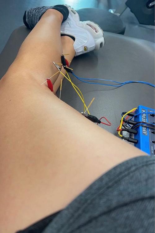 Girl receiving acupuncture-like needles hooked up to electric clips.