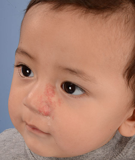 after photo of boy with nasal hemangioma removed