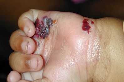 Infant hand with epidermolysis bullosa