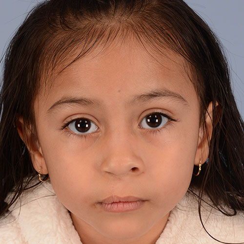 after unilateral cleft lip and palate