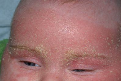 Infant forehead with seborrheic dermatitis