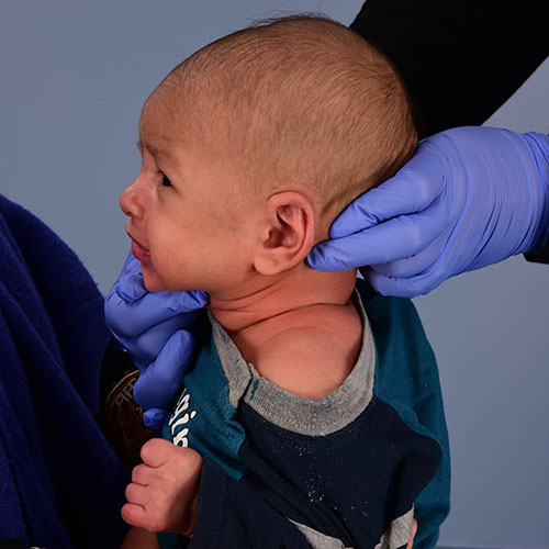 baby born with Cryptotia of his left ear and had non-surgical ear molding treatment