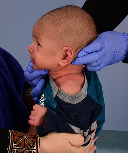 baby born with Cryptotia of his left ear and had non-surgical ear molding treatment