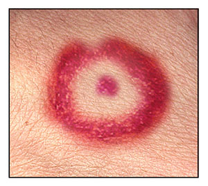 Lyme disease mark