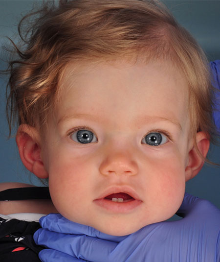 after photo of baby girl with sagittal strip craniosynostosis treated at Children's Health