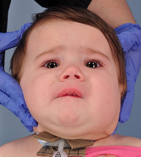 after venolymphatic malformation removal from infant