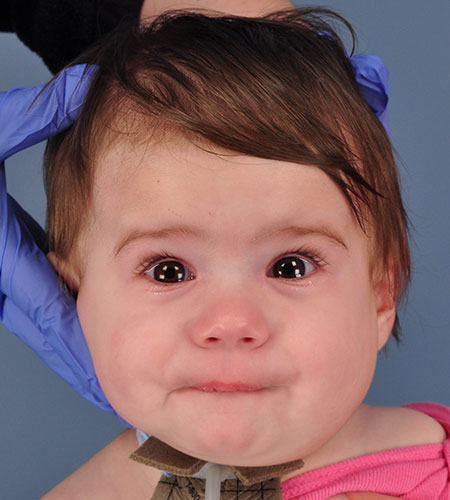 after venolymphatic malformation removal from infant