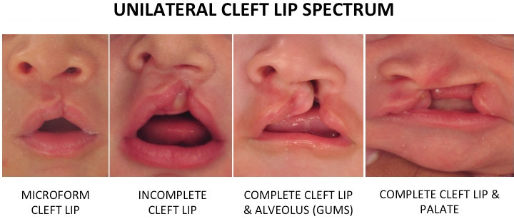 Spectrum of cleft lip conditions