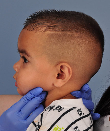 after photo of toddler boy with hemangioma removed