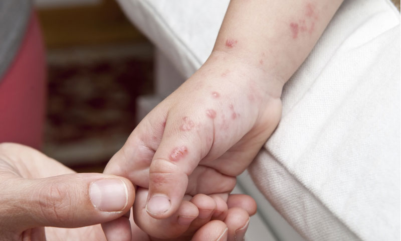 Shingles In Children Chickenpox Shingles Children S Health